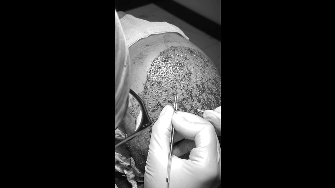 Hair transplant by FUE method