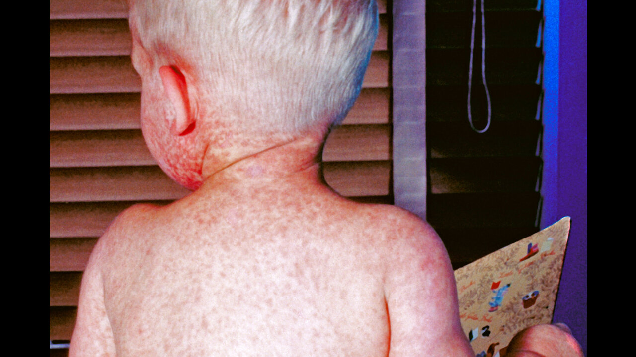 Covid-19 Vaccine Cripples and kills Thousands