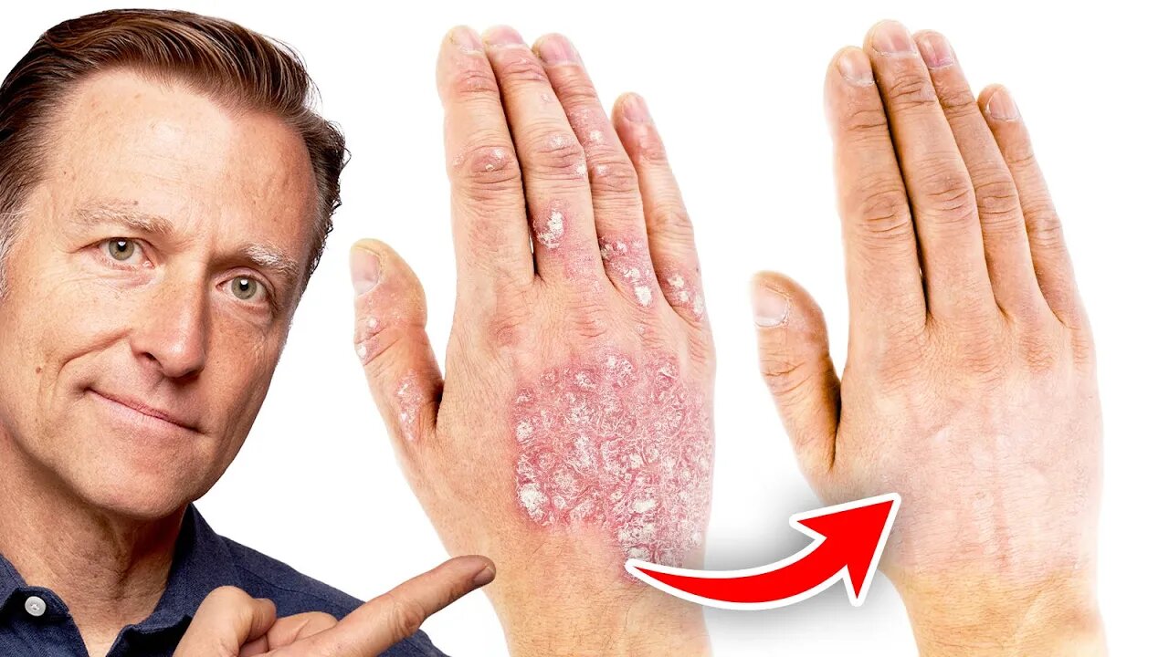 The #1 Best Remedy for Eczema