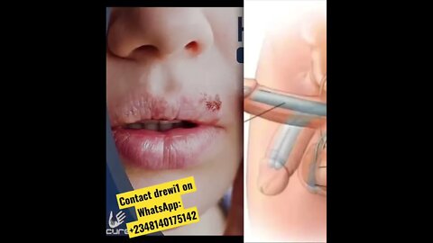 Contact me to order herpes cure cancer,hiv,diabetes,etc my herbal medicine cure all types of disease