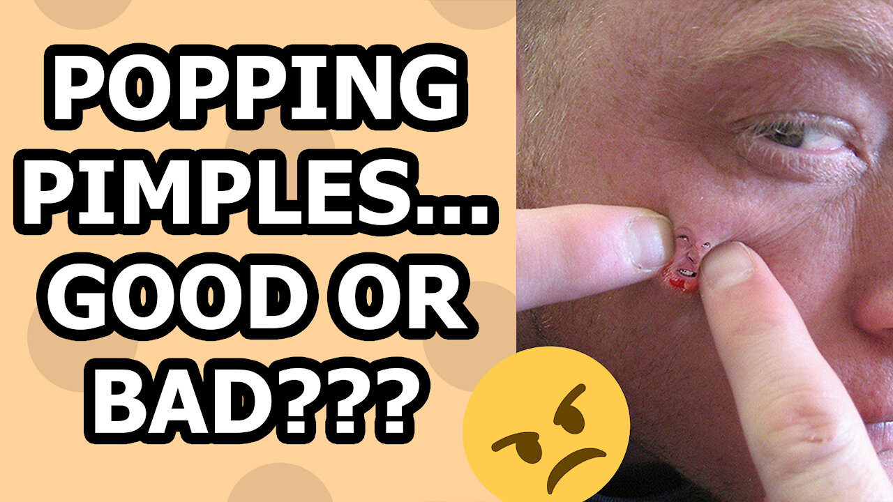 Popping Pimples - The Things You Should Know!!