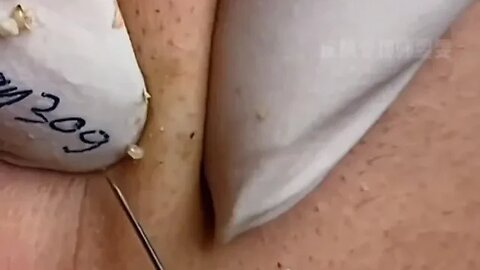 Removing blackheads
