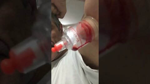 Ventosa terapia remoção de sangue pisado