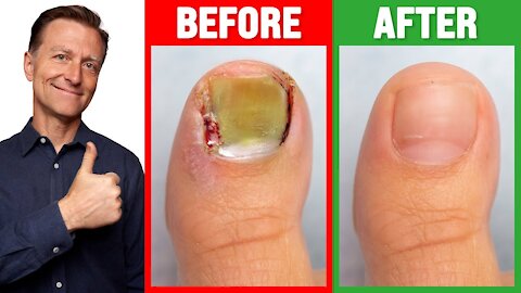 CURE Toenail Fungus for Less than $2.00 - Dr. Berg