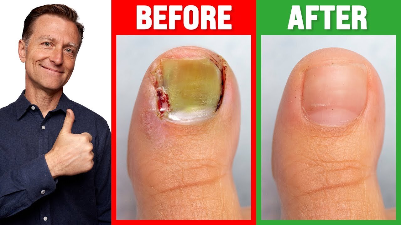 CURE Toenail Fungus for Less than $2.00 - Dr. Berg