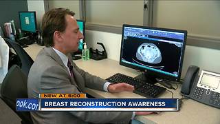 Exploring options for breast cancer patients