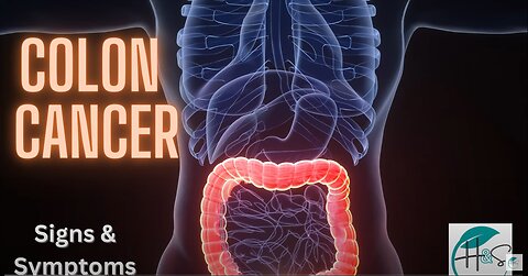 Colorectal Cancer I signs symptoms Risk Factors Treatments