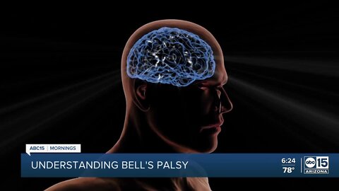 Health Insider - Understanding Bell's Palsy