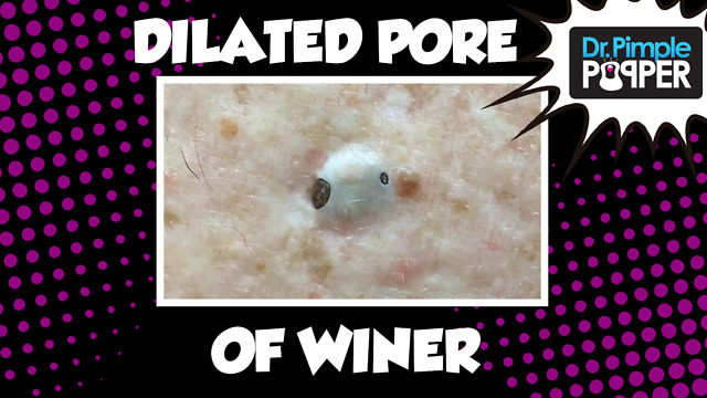 Dilated Pore of Winer (Giant blackhead!)