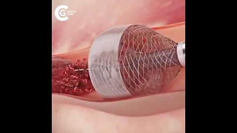 Coronary Thrombectomy