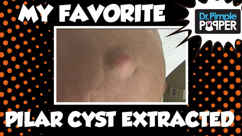 One of my FAVORITE Pilar Cysts extracted - via Suspension Suture