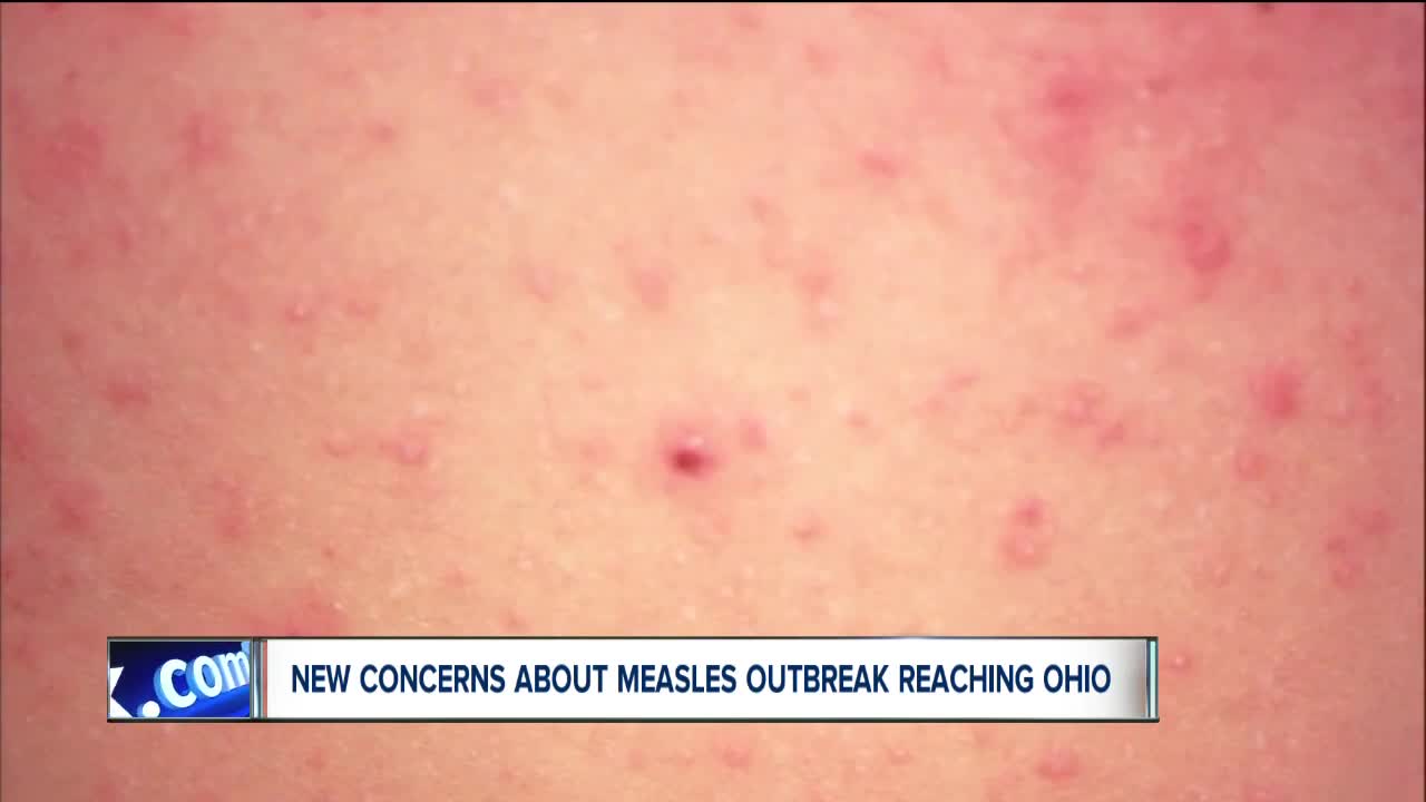 Holiday travel could potentially bring measles outbreak to Ohio