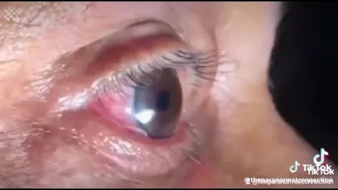 The Infected Eye