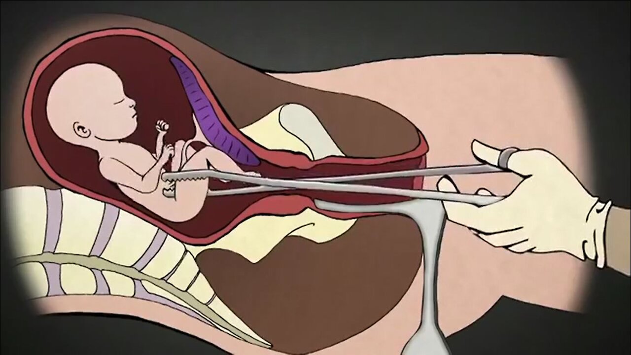 2nd Trimester Abortion Procedure | Dr. Anthony Levatino - Former Abortionist Turns Pro-Life