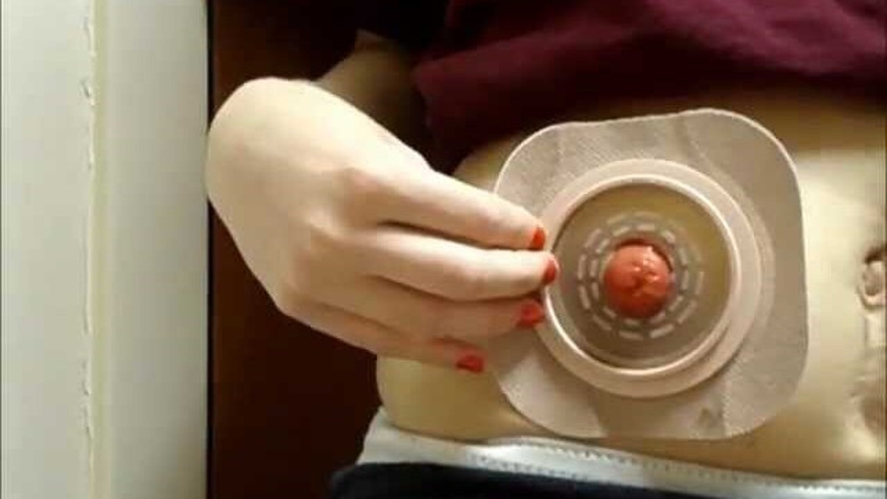 On-the-Go 5 Minute Ostomy Change!