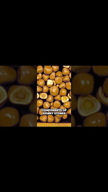 The Astonishing Powers of Citric Acid Unlocking its Secrets for Kidney Stone Prevention