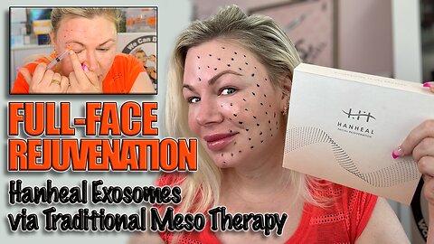 Full Face Rejuvination with Hanheal Exosomes traditional Meso! AceCosm.com code Jessica10 Saves