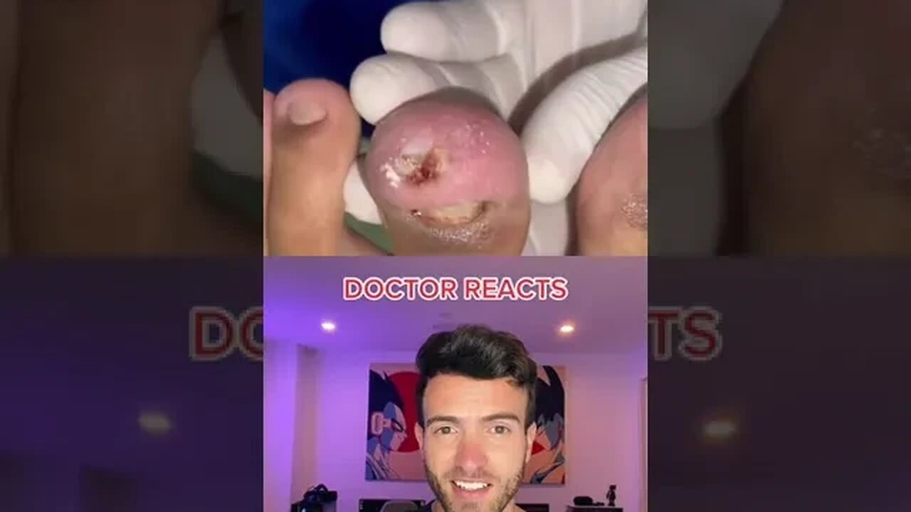 Worst Ingrown Nail I Have Ever Seen