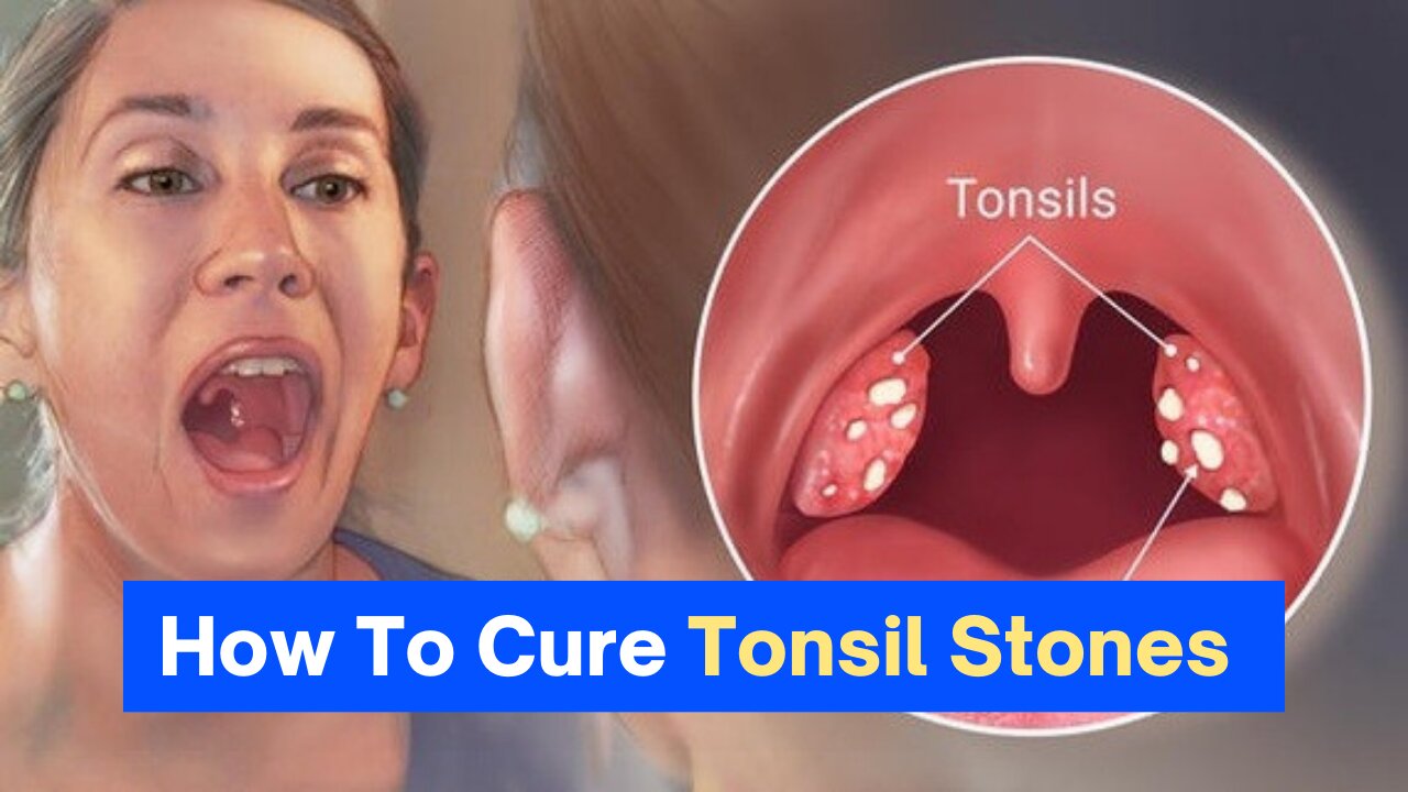 Stop Suffering From Tonsil Stones