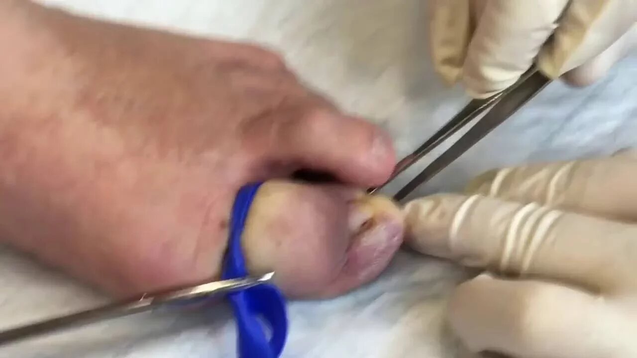 Complete Nail Removal and chemical Matrixectomy