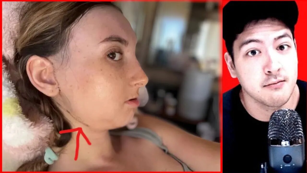 GIRL GETS BULLIED INTO $200,000 JAW SURGERY, IZZY SEHON