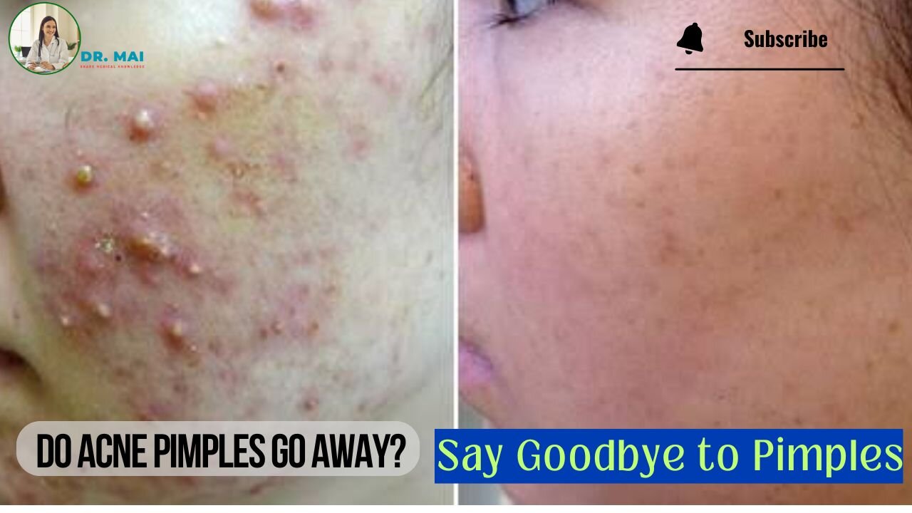 Do Acne Pimples Go Away? | DR. MAI