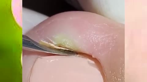 #toenail #toenailremoval #ingrowntoenail #satisfying #nails