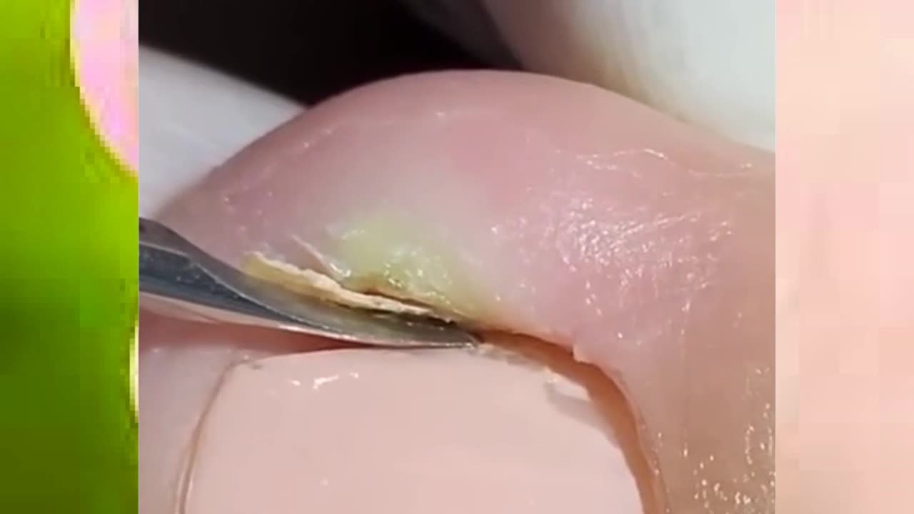 #toenail #toenailremoval #ingrowntoenail #satisfying #nails