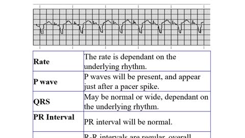 Basic ECG Interpretation Part 2