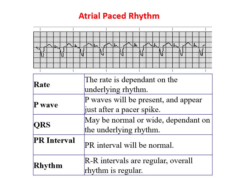 Basic ECG Interpretation Part 2