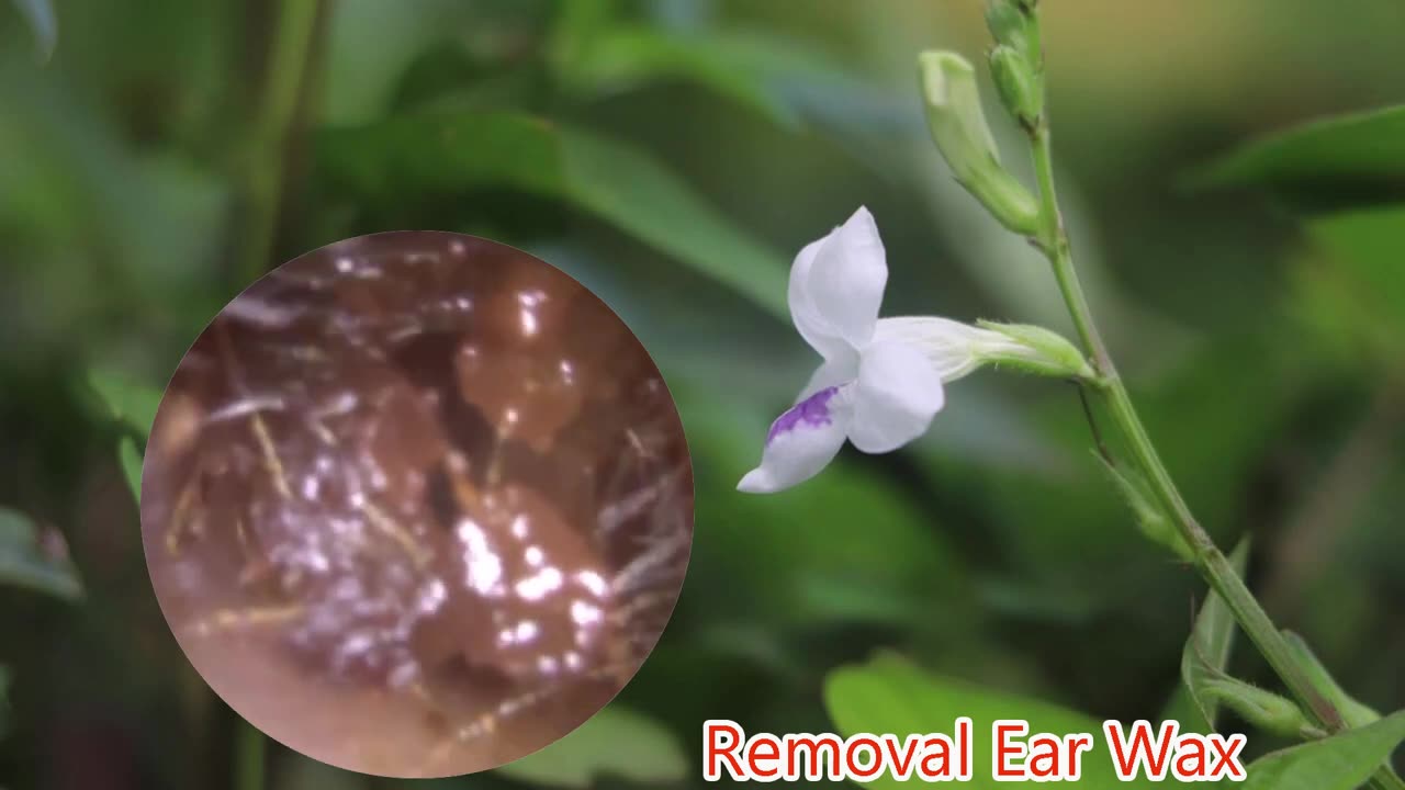 gigantic ear wax removal #5