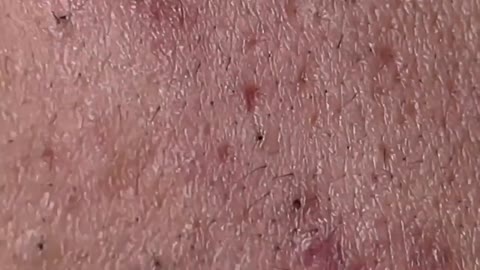 Satisfying blackhead relaxing