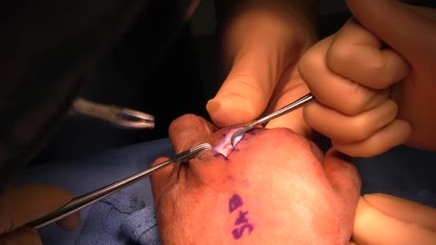 Tenolysis - Dr. Scott Barbour