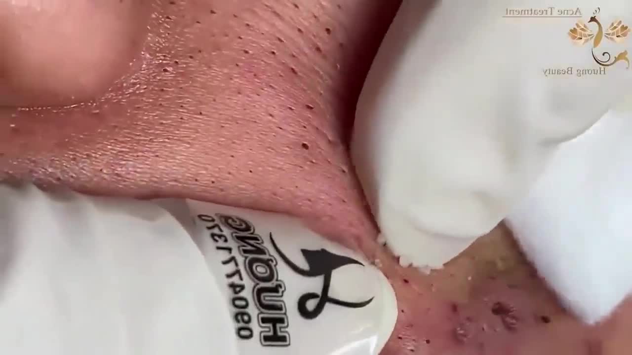 Blackheads & Milia, Big cystic acne blackheads extraction whiteheads Removal Pimple Popping.