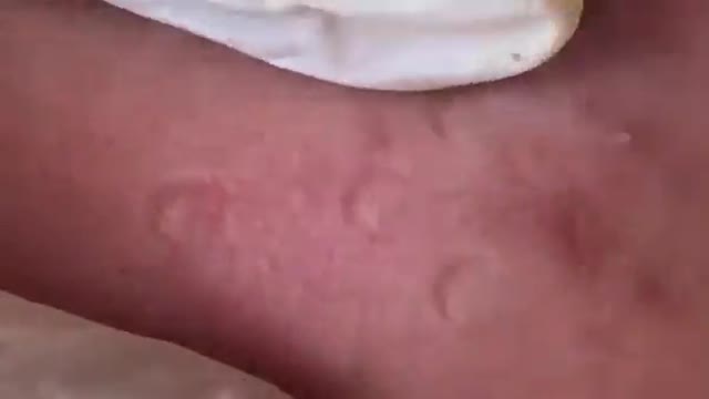 EXTREME PIMPLE POPPING CYST EXPLOSION BLACKH