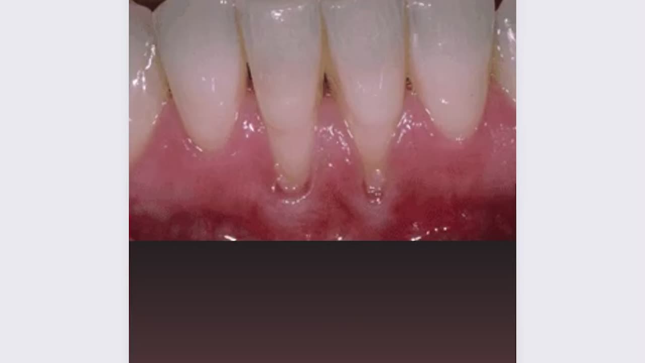 How to stop receding gums| tissue grafting #periodontics#dentalcare