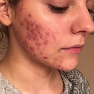 If you have acne scars you HAVE to try this #shorts #skincare