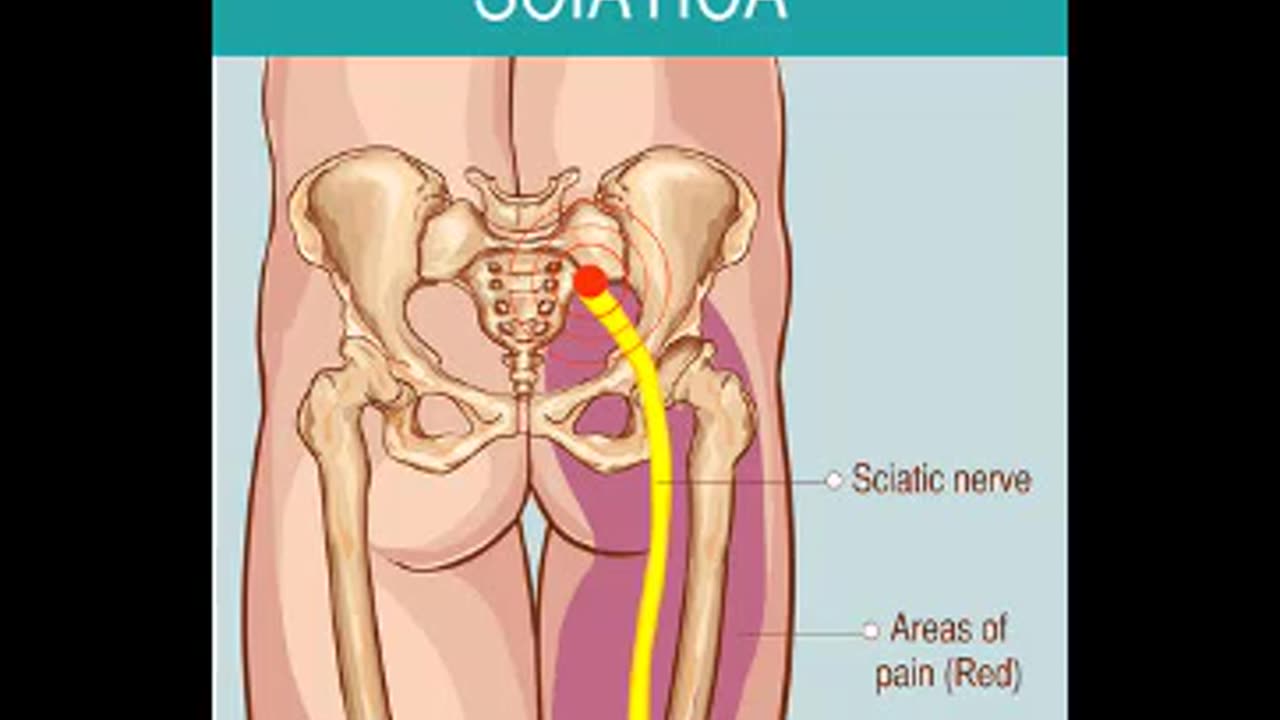 Sciatica Treatment 20 minutes Use of Headphones is required