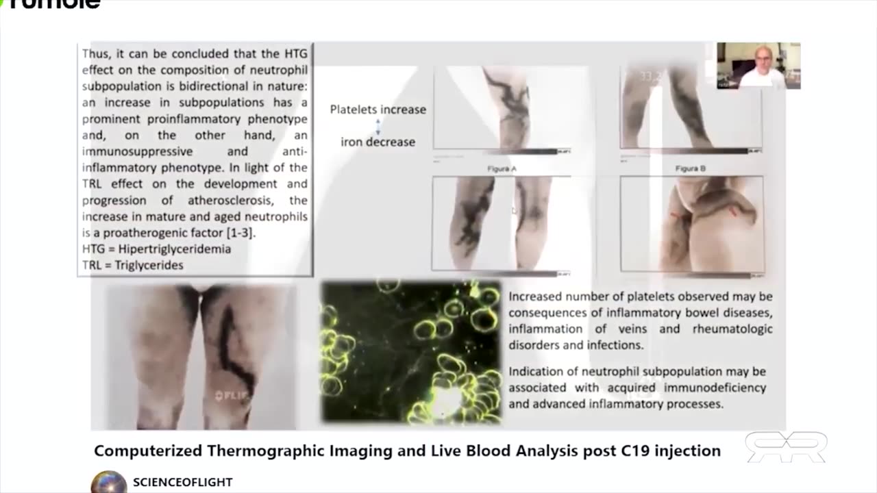 Thermographic Imaging Shows Massive Blood Clots in the Asymptomatic Vaxxed