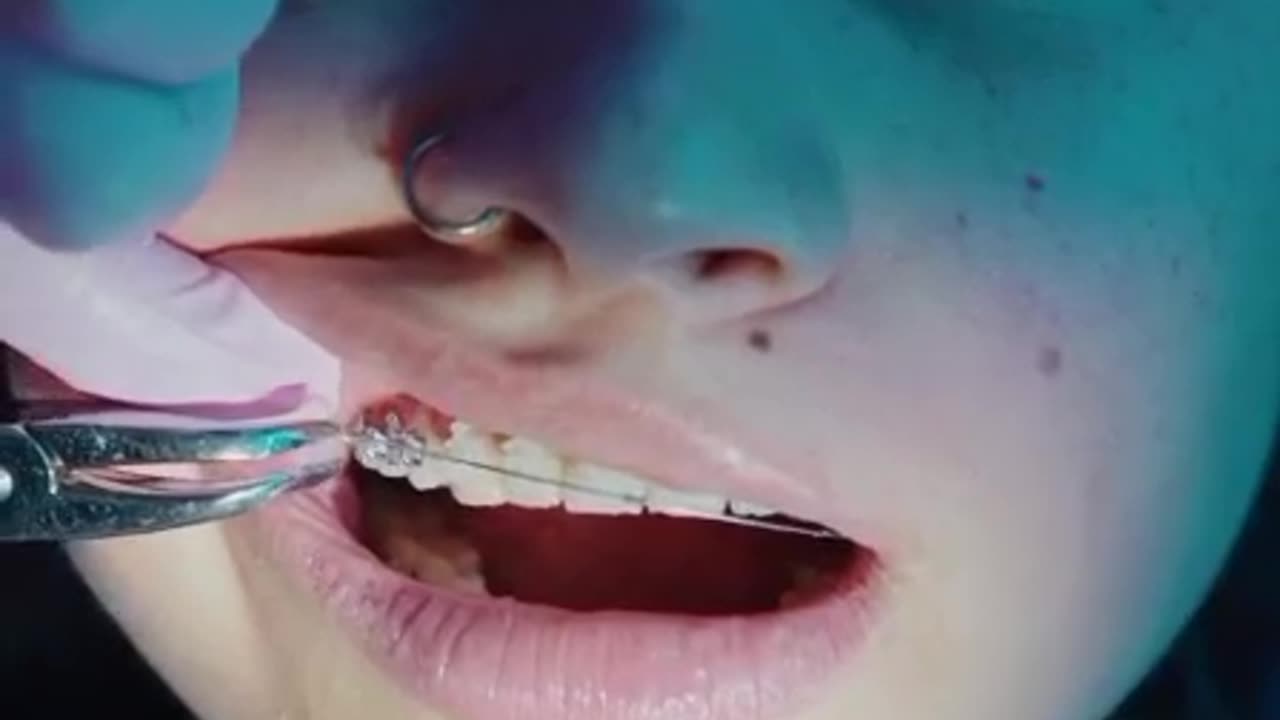 surgical orthodontics straighten your teeth