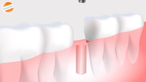 Tooth Insertion