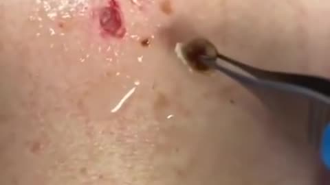 Big blackhead removing