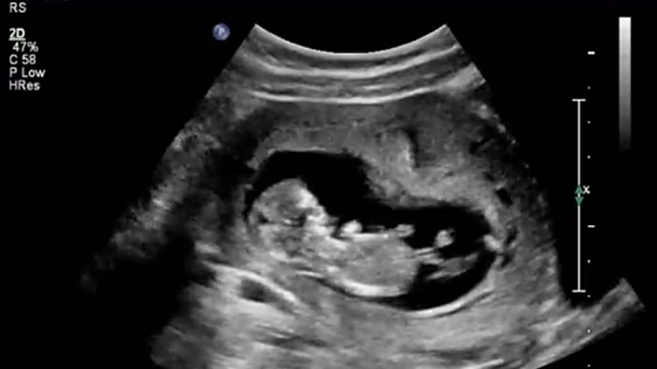 Amazing Ultrasound Shows 11-Week Unborn Baby Jumping in the Womb