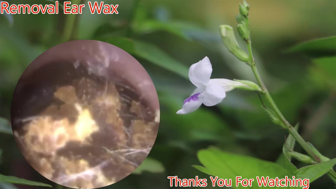 gigantic ear wax removal #1