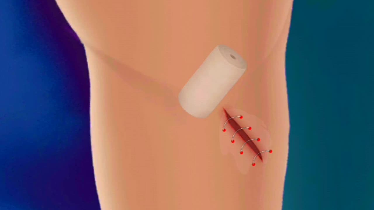 How to Hand cut Treatment In 3d Animation #shorts #short #rumble #viral #science #animation