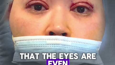 Benefits of Awake Double Eyelid Surgery | Dr. Kenneth Kim Explains
