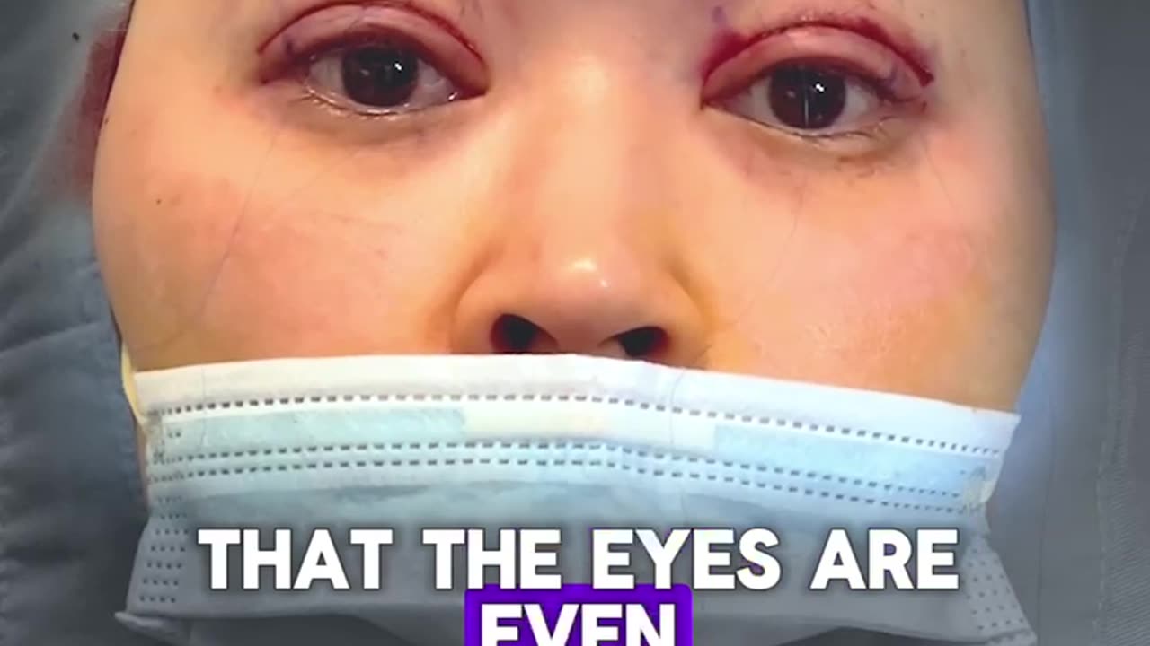 Benefits of Awake Double Eyelid Surgery | Dr. Kenneth Kim Explains