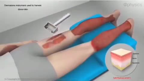 Skin grafting technique