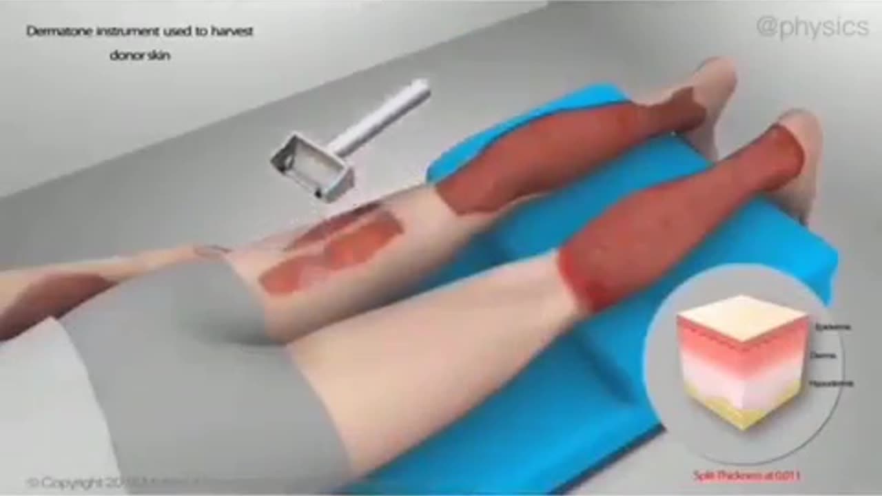 Skin grafting technique