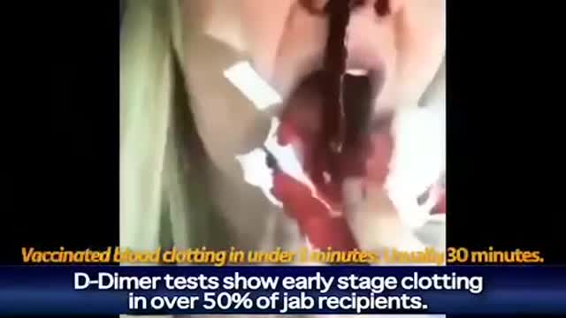 Alarming cases of heart problems in athletes after vaccination